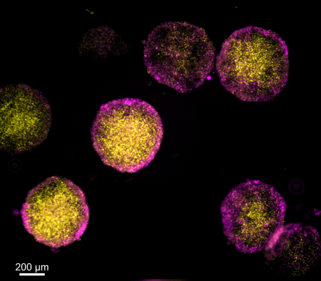 October Sky Dahlias (Hannah Brien) Immunocytochemistry/fluorescence microscopy of human embryonic stem cells (hESCs) cultured in 500um microdiscs and stained for germ layer markers. Yellow - SOX2 (pluripotency/ectodermal marker), pink - brachyury (mesendodermal/primitive streak marker). Fabricated in the VINSE facilities using the Jelight M42 UV Ozone Cleaner