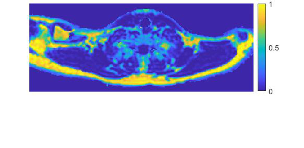 Fat-water MRI in studies of human brown adipose tissue