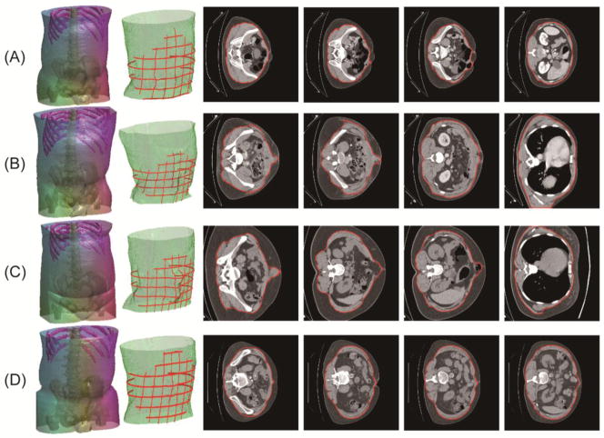 Segmentation results for four subjects. The first column represents the results of bone skeleton and skin. The second column demonstrates the segmentation of outer abdominal wall (green) overlaid with grids of labeled ground truth (red). The third to the sixth columns show the intra- and inter- variability of abdominal wall over slices and the segmentation results of our approach (red).