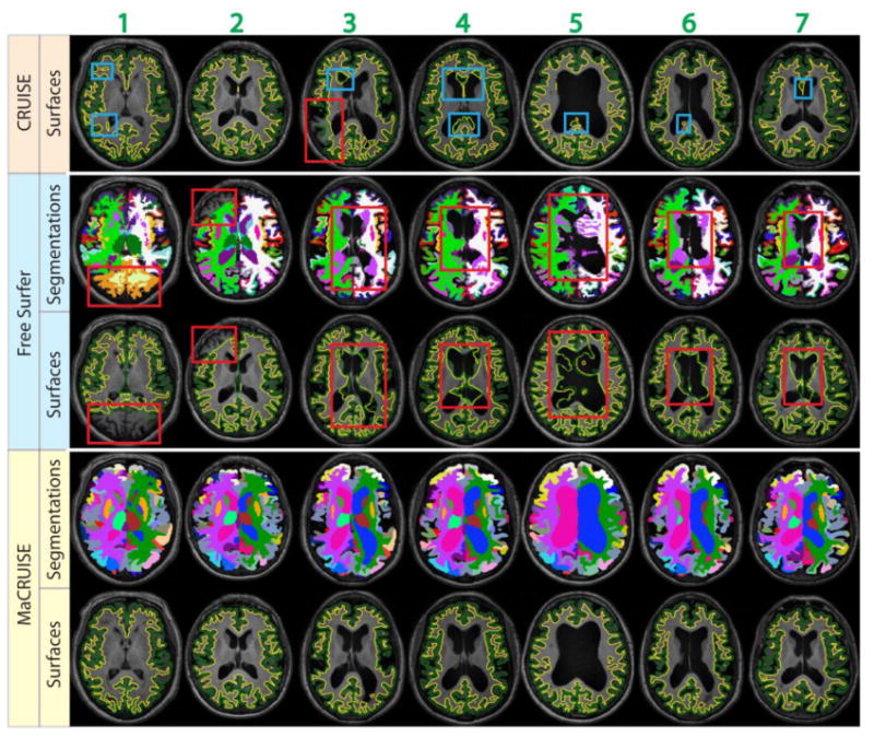 This figure shows the failures for seven problematic volumes. Both whole brain segmentations and cortical surfaces on axial slices are provided. The areas in red rectangles show the global failures while the areas in blue rectangles show the local failures. MaCRUISE did not exhibit such failures in any images.