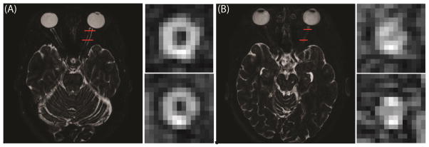 Comparison of the ON of a healthy control (A) and an MS patient with severe ON atrophy (B). Red lines in the axial images show the location of the coronal slices to the right.
