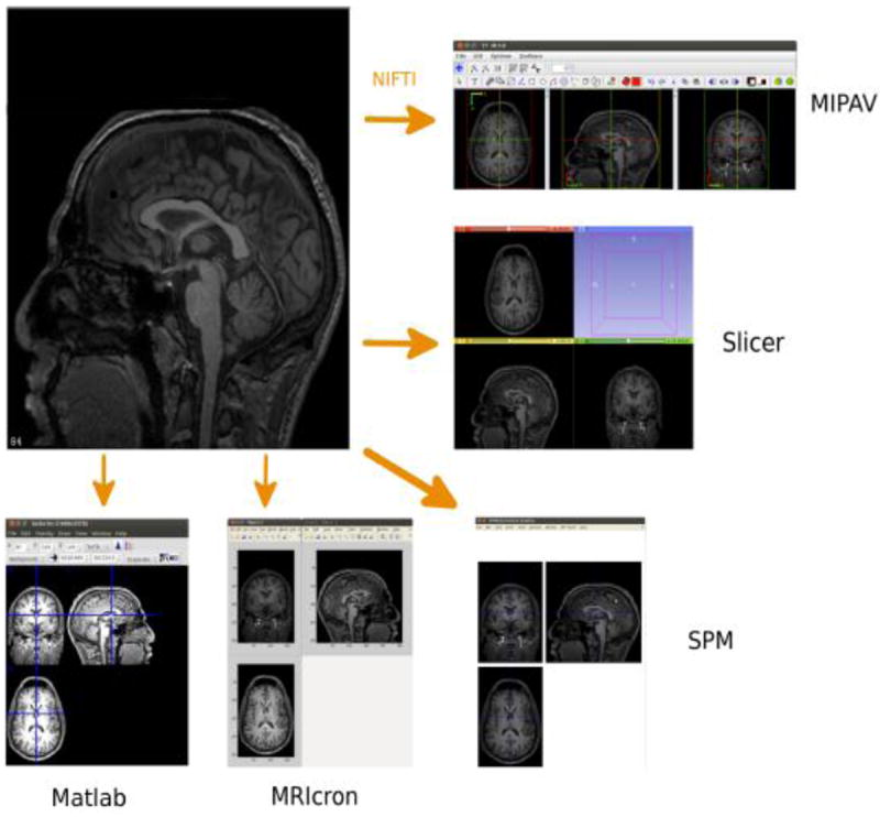 DICOM can be converted into research file formats viewed with SPM[7], MIPAV[8]. 3D Slicer[9]. MRIcron[10], MATLAB (Mathworks, Natick, MA)