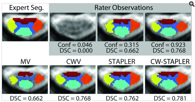 Qualitative fusion results. A representative slice shows the effect of the additional confidence parameter on the output of both the voting and statistical fusion techniques. The three rater observations (one submitted empty) are shown. In this example, CWV and “Best Pick” would result in an identical segmentation.