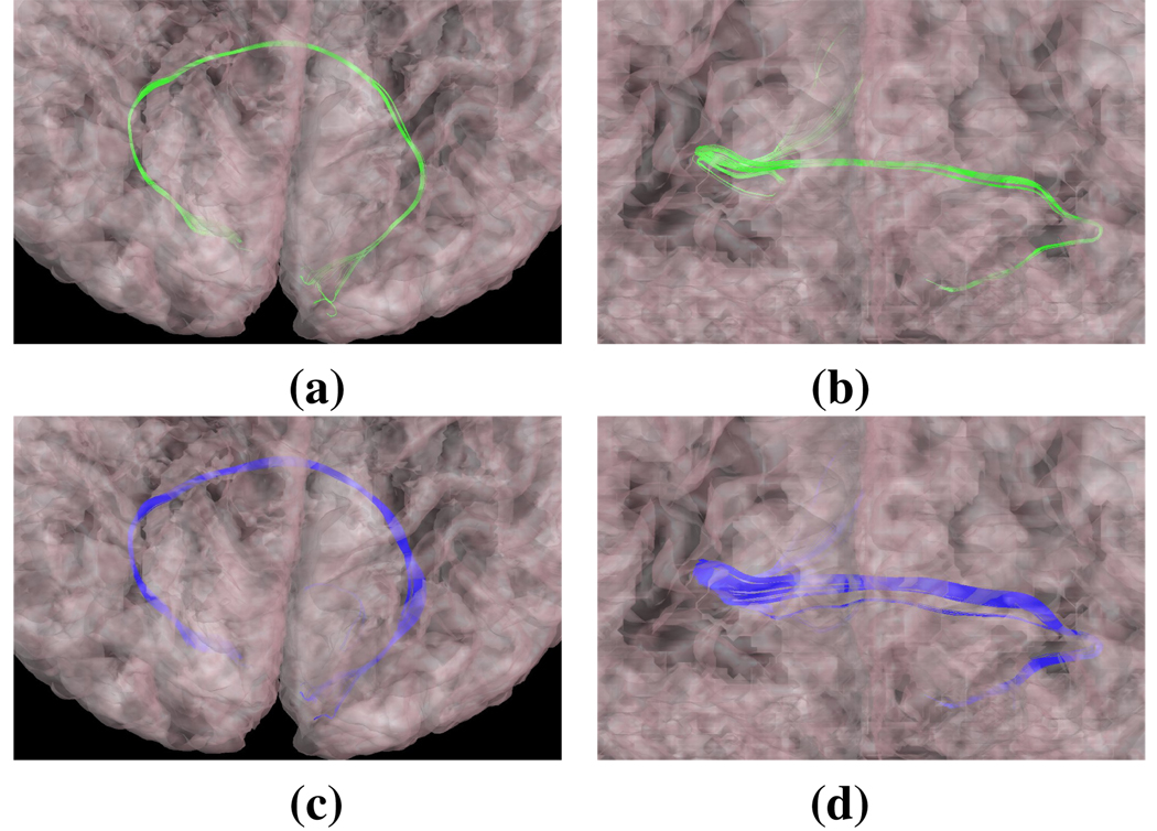 Orthogonal views of the Forceps Major delineated (a–b) manually and with our (c–d) automated processing. The semi-transparent cortical outer surface is also shown.