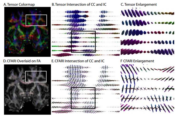CFARI identified consistent intra-voxel structure in the crossing fibers between
the corpus callosum (CC, lower left, red) and internal capsule (IC, blue, lower right).
Conventional tensor modeling does not preserve the connectivity of the corpus callosum
to the lateral hemispheres