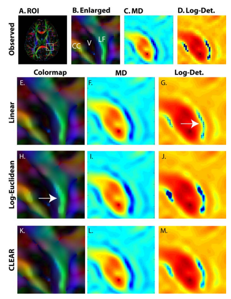Interpolation of the genu of the Corpus Callosum (CC) and longitudinal fasciculus
(LF) near the lateral ventricle (V): region of interest (ROI) selected on an
orientation color coded anisotropy map (A,B). MD (C) and log-determinant (D) are
shown at the reconstructed resolution. Upsampled (4 × 4) and interpolated contrasts
are shown for linear (E-G), Log-Euclidean (H-J), and CLEAR (K-M) tensor interpolation.
While the linear interpolation has smooth FA and MD (E,F), it exhibits abrupt
changes in the determinant (G). The Log-Euclidean interpolation exhibits FA artifacts
in regions of high anisotropy and curvature (H). CLEAR avoids all these problems