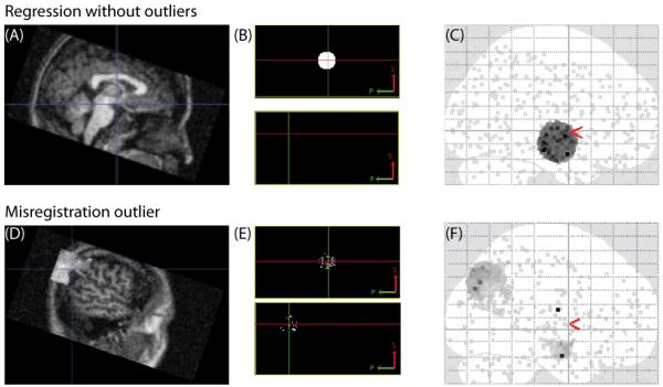 mpact of outliers in BPM. (A) is one of the regressor images without outliers. The main modality images are: Y = 3X inside a spherical region, Y = constant outside the region. (B) is the Beta estimation when there are no outliers. (C) is the significant results when there are no outliers, (D) is the shifted regressor image, the center cube shifts to another region. The center cube of the paired main modality image shifts to the same region. (E) is the estimated Beta from original BPM when there are outliers. (F) is the significant results from original BPM when there are outliers.