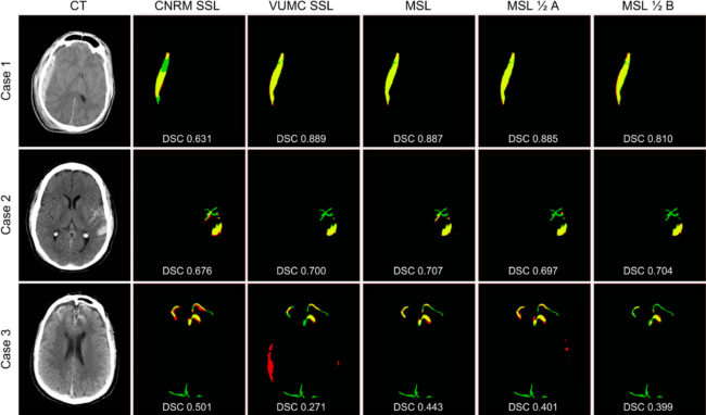 Figure 4 Results of automatic segmentations compared with manual gold standard for each training method for three cases representing a range of DSCs (top quartile — Case 1 (VUMC dataset), median — Case 2 (CNRM dataset), and bottom quartile — Case 3(VCU dataset)). For each case, manual segmentation only (FN) is green, automatic segmentation only (FP) is red, and the overlap of manual and automatic segmentations (TP) is yellow. Black is TN. Corresponding DSCs are overlaid. As we aim to show that MSL generalizes across different institutions on average, we encourage consideration of DSCs as a whole rather than the individual cases.