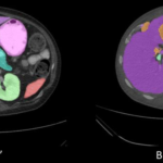 Examples of segmentations generated by the baseline algorithm. A. An inlier, where the algorithm correctly predicted larger organs, like the liver (on the left side of image in purple) and spleen (on the right side of image in red- pink) and suggested mostly accurate areas of smaller organs. B. An outlier (global failure), where the liver (purple) and spleen (red-pink) were largely correct but major inconsistencies are visible with other organs.