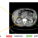 Figure 1. Renal structures segmentation of clinically acquired CT image. Yellow box shows a representative right kidney, green box shows the left kidney. The zoom-in patches show the CT kidney field-of-view (FOV) and labels. The label patches display the renal cortex (blue), the medulla (red) and the pelvicalyceal system (green). Those small structures make automatic renal segmentation challenging.