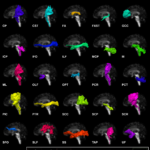 Average shape and position of all bundles that are part of the TractEM protocol (association and projection pathways are shown only for the left hemisphere). The average was computed using segmentation from 4 raters and 4 datasets (BLSA) using a majority vote. This highlights the general agreement on the shape, but as seen in the lower right vignette the variability of each individual segmentation can be quite extreme.