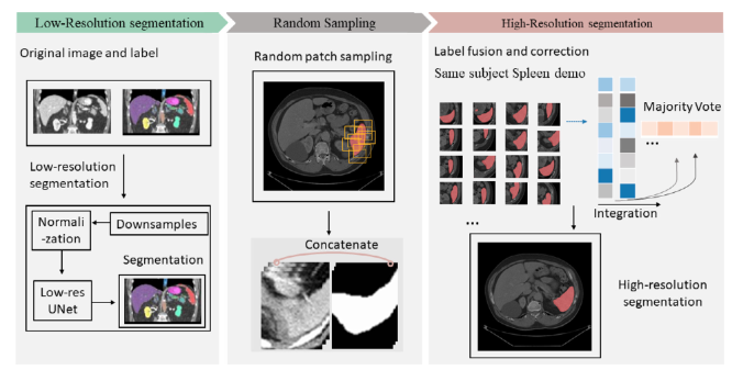 Method framework. Given a CT scan with at high resolution of ~0.8 x ~0.8 x ~2 mm, a low-res section (left panel) is trained with multi-channel segmentation. The low-res part contains down-sampling and normalization in order to preserve the complete spatial information. After the coarse segmentations are acquired from low- res UNet, we interpolate the mask to match the image’s original resolution. Next, random patch sampling (mid panel) is employed to collect patches, and patches are concatenated with corresponding coarse segmentation masks. Finally, we trained a patch-based high-res (right panel) segmentation model, the high-dimensional probability maps are acquired from integration of all patches on field of views. Majority vote is used to merge estimates into a final segmentation.