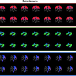 Mosaic of dissections of the first timepoint of the first HCP subject from 20 raters (left), all dissections look extremely similar. On the right, the average dissection (gold standard) in both the streamlines and the voxel representations. The coloring is based on the orientation of each streamline, where the X/Y/Z differences are mapped to R/G/B. To be considered part of the gold standard, elements had to be labeled in at least 50% of dissection associated with each subject. The PYT had a more consistent spatial coverage compared to the first Tractostorm project (only bundle in common)