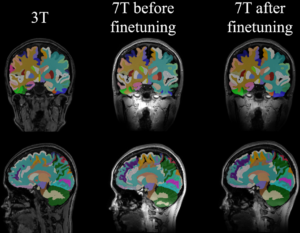 The sagittal and coronal slices with overlays of segmentations from SLANT on 3T MRI, SLANT on 7T MRI and finetuned SLANT on 7T MRI are shown. Some of the labels such as the left cerebellum white matter show clear improvement in the segmentation boundaries in the sagittal slices.