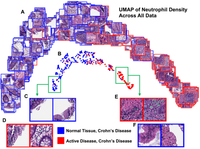 UMAP of the normalized histogram representation of WSI neutrophil density for the entire dataset. All patches in this figure depict the 256 × 256 pixel CLAM patch with the maximum neutrophil density from the corresponding WSI. The UMAP displayed with patches depicts more clearly visible crypts and tissue edges in the normal cluster max patches than the active disease cluster (A). The UMAP displayed with circle markers highlights the separability of the two classes (B). Example patches are shown with their predicted neutrophil segmentation in green (C, D, E, F). Looking deep into the normal cluster, expected patches (C) and active disease outliers (D) show tissue edges and few segmented neutrophils. In the active disease cluster, expected patches (E) and normal tissue CD outliers (F) both show a larger number of segmented neutrophils, with fewer tissue edges visible (F).
