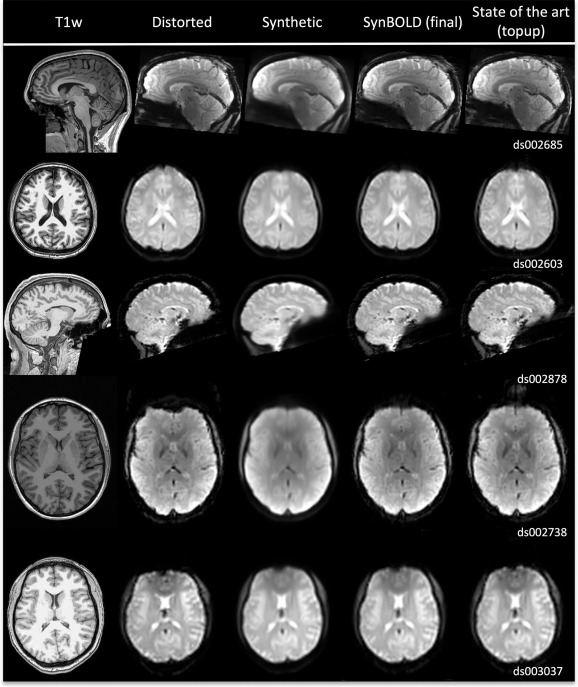 Distortion correction of functional MRI without reverse phase encoding ...