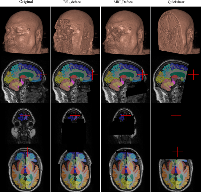 Example of type II failure cases. The columns from left to right show the unaltered (original) data and the results of FSL_deface, MRI_Deface, and Quickshear. The rows from top to bottom show 3D renderings of the head before and after defacing by the three algorithms, then sagittal, coronal, and axial slices with their corresponding SLANT segmentation overlaid. The red cross marks the same position in each image and shows where brain voxels are removed by defacing.