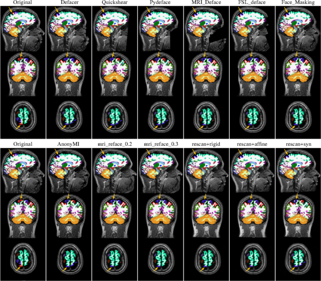 Fig. 6 FreeSurfer outlier comparison. MRIs overlaid with their corresponding FreeSurfer segmentations. The arrows point to a location where the label given by FreeSurfer segmentation changed dramatically after processing either by a defacing algorithm or the registration of the rescan image. We repeat the original FreeSurfer results on both the top and bottom left column for easier comparison across the rows.