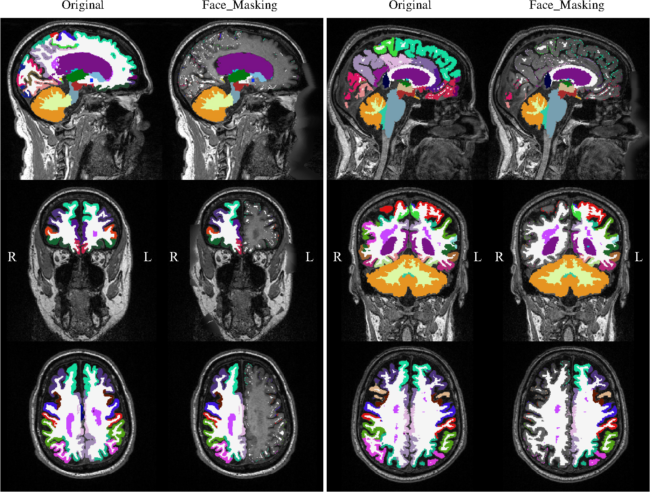 Fig. 7 Two FreeSurfer outliers. MRIs overlaid with their corresponding FreeSurfer segmentations. The left two columns are results from unaltered (original) MRI and defaced by Face_Masking for one subject, and the right two columns are from another subject. These are the worst two subjects in our comparison with mean DSC below 0.7. Key: “L” denotes left and “R” denotes right.