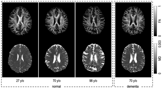The premise of this effort is that the brain undergoes macrostructural and microstructural changes throughout the normal aging process. At left above, we can appreciate that there are microstructural changes—as shown in fractional anisotropy (FA)—mainly characterized by a decrease in FA (top row). Additionally, there are diffusivity changes, with increased diffusivity in the white matter, notably in the central white matter, as shown in mean diffusivity (MD) (bottom row). We would like to know if prediction of the chronological age from microstructure could provide a useful biomarker to detect abnormal aging as a difference between the age one might predict from a participant with dementia (shown right), versus their true chronological age.