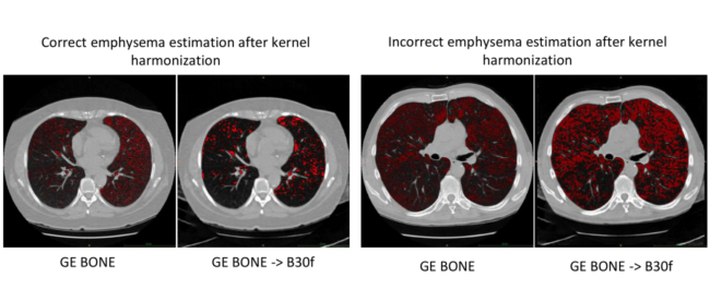Emphysema quantification of GE BONE after kernel harmonization to B30f remained challenging. Although harmonization correctly reduced emphysema variation (left) in a few subjects, emphysema in the majority of subjects was over estimated (right).