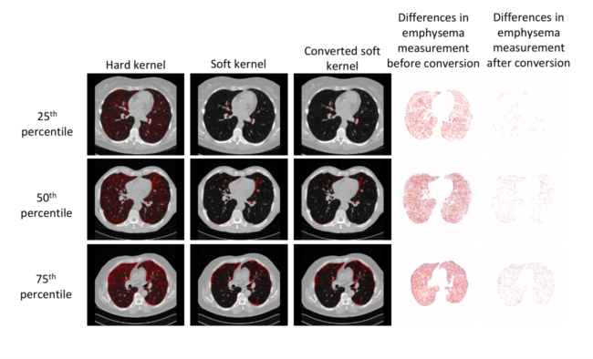 Figure 5. Emphysema measurements in CT images vary across subjects. Furthermore, the reconstruction kernel affects the emphysema measurement, creating a difference in measurements obtained. Soft kernels are favorable for emphysema measurement. The conversion from a hard to soft kernel minimizes the measurement errors, that can be observed with the help of emphysema masks obtained before and after conversion.