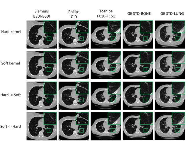 Figure 7: Noise introduced during computed tomography reconstruction leads to differences in textures of underlying anatomical structure. Harmonization between kernels within a given manufacturer enforces consistency in the texture of underlying anatomical structures that benefits quantitative image assessment.